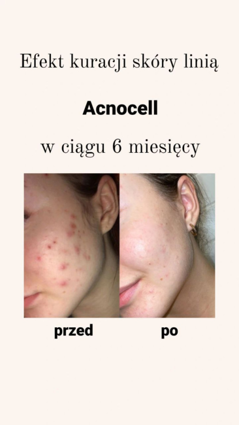 AcnoCell Clay Mask | Maska glinkowa do skóry problematycznej AcnoCell Clay Mask | Maska glinkowa do skóry problematycznej