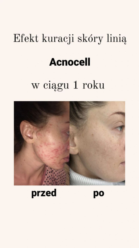 AcnoCell Clay Mask | Maska glinkowa do skóry problematycznej AcnoCell Clay Mask | Maska glinkowa do skóry problematycznej