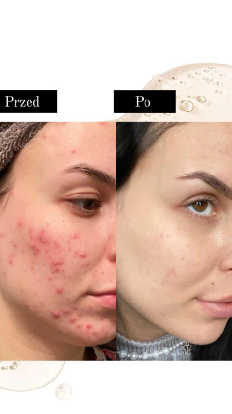 AcnoCell Mild Cleanser | Żel do mycia skóry tłustej, problematycznej, trądzikowej AcnoCell Mild Cleanser | Żel do mycia skóry tłustej, problematycznej, trądzikowej
