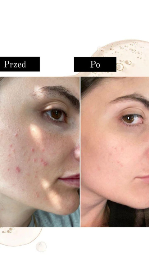 AcnoCell Mild Cleanser | Żel do mycia skóry tłustej, problematycznej, trądzikowej AcnoCell Mild Cleanser | Żel do mycia skóry tłustej, problematycznej, trądzikowej
