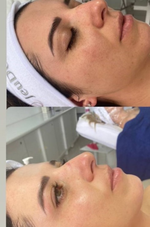 Nova Complex | Chemiczny peeling kwasowy do skóry normalnej | JeuDerm