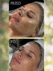 Zestaw do zabiegu "Peeling Anielski" | Rozjaśnienie przebarwień | JeuDerm