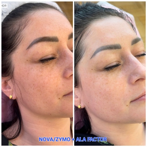 Zymo Complex | Peeling chemiczny do skóry wrażliwej | JeuDerm