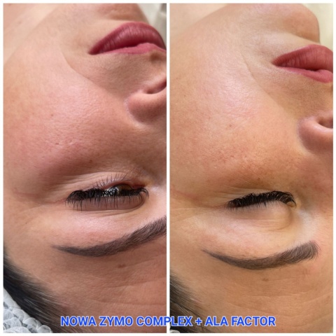 Zymo Complex | Peeling chemiczny do skóry wrażliwej | JeuDerm
