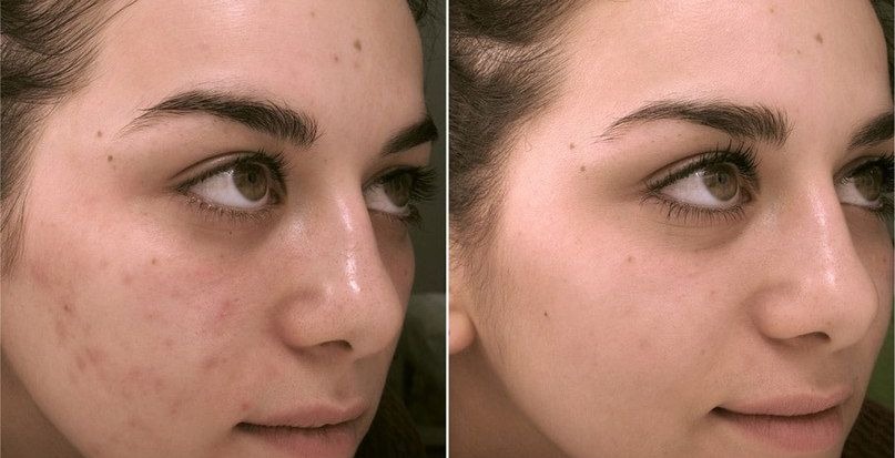 Cream Demela JeuDerm до та після