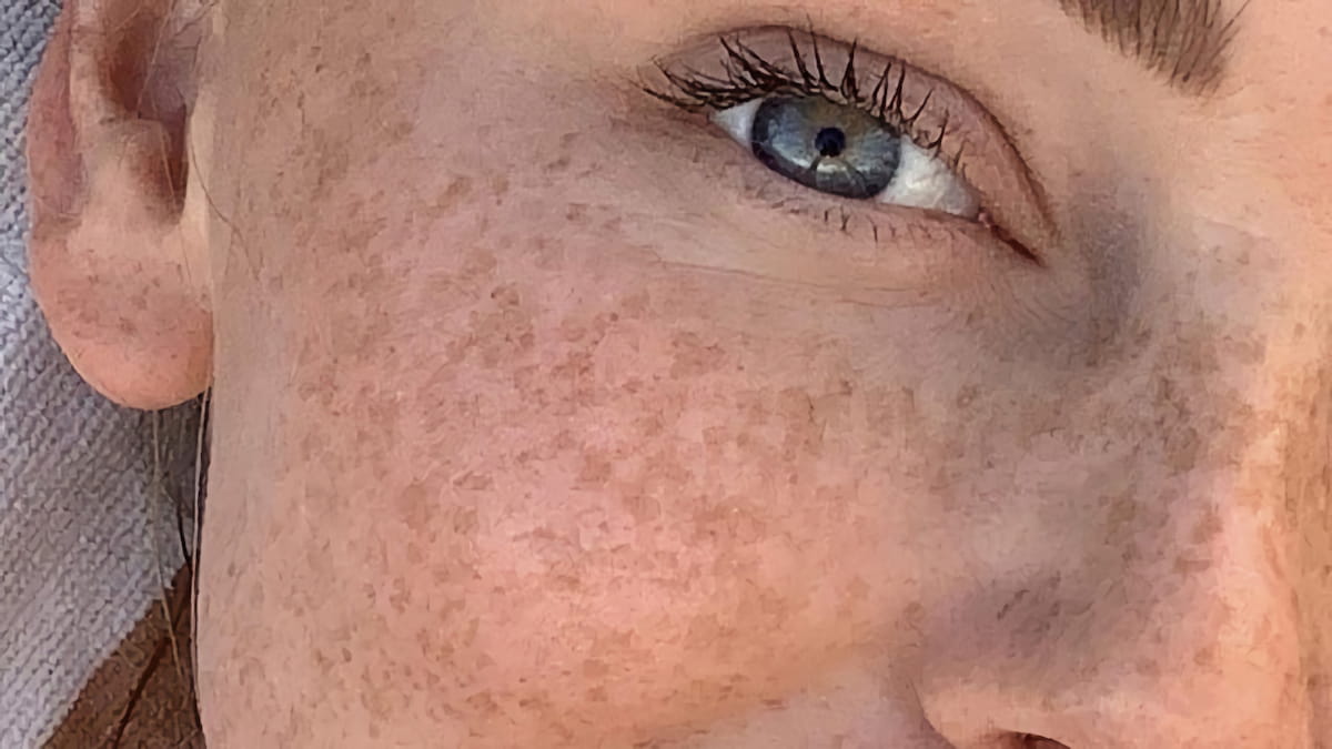 Пігментні плями